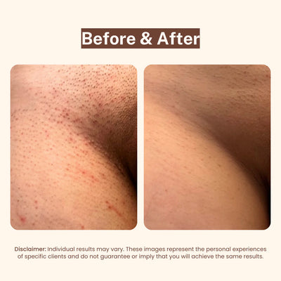 Bikini Line Serum
